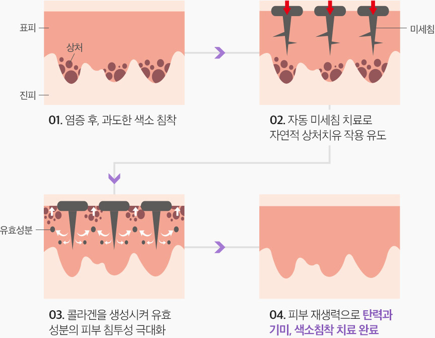 로하 오토 미세침