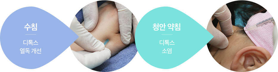 수침/청안 약침